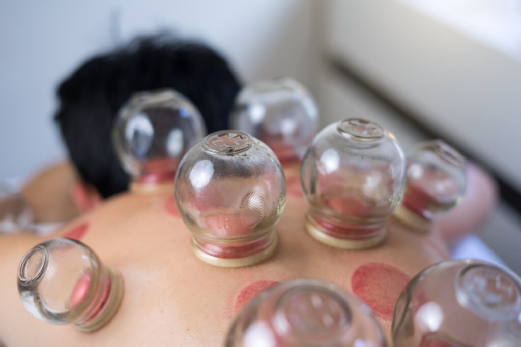 cupping therapy in tracy